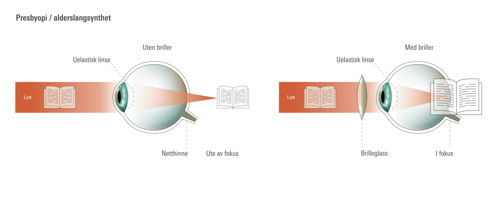 Øyets anatomi ved presbyopi