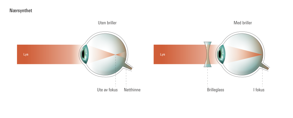 øyets anatomi ved nærsynthet