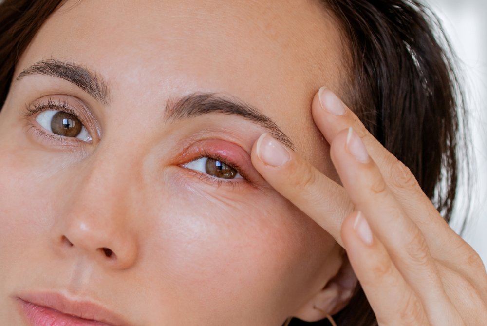 Dame med chalazion på øvre øyelokk